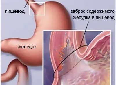 Рефлукс се третира