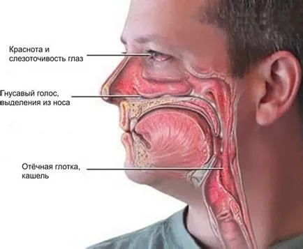 Риносинузит - причини, признаци, симптоми и лечение