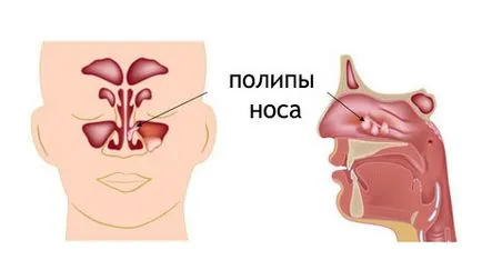 Риносинузит симптоми и лечението на остра, хронична, полиповидно