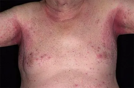 Обрив и сърбеж по тялото на лечение на възрастни на болестни причини и снимки
