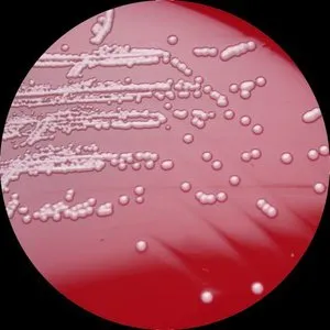 Staphylococcus Haemolyticus (хемолитична стафилококус ауреус) при мъжете симптоми, цитонамазка и култура в
