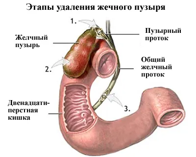 отстраняване на жлъчния мехур (холецистектомия)