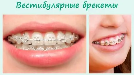 Видове скоби за зъби снимка скоби и зъбите преди и след лечението