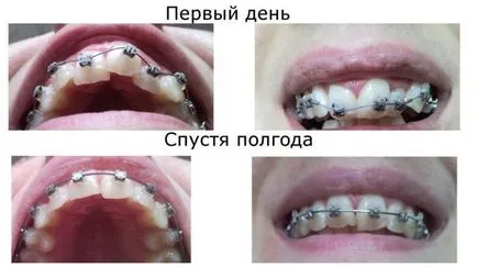 Видове скоби за зъби снимка скоби и зъбите преди и след лечението