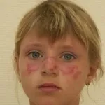 Лупус снимка, симптомите и лечението на болестта (симптом) Лупус снимка, симптоми и лечение на заболяването