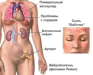 Лупус снимка, симптомите и лечението на болестта (симптом) Лупус снимка, симптоми и лечение на заболяването
