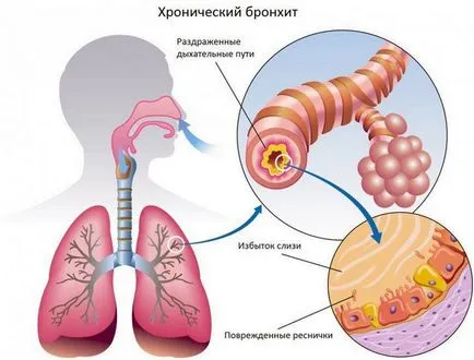Хронични симптоми бронхит при възрастни, лечение на народната медицина