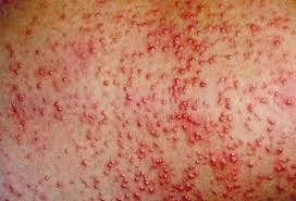 Allergy под формата на мехурчета, алергии (например мехурчета) Allergy под формата на мехурчета, алергии