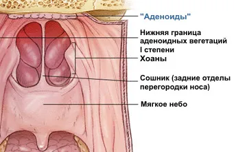 Аденоиди в носа при деца и възрастни, симптоми и лечение лазер (лазерно лечение) - вашето здраве