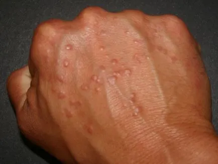 Алергия към ръцете под формата на мехурчета - и лечение (алергия) Allergy на ръка под формата на мехурчета - лечение и