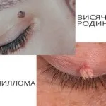 Рака или мол различават, снимки разлики