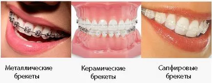 Цени за скоби - как да си изберете евтини скоби - Dental Portal (евтини) Цени за скоби - как да се избират евтини скоби - Стоматологичен портал