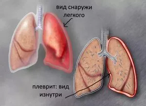 Какво е това - плеврални слоеве с рентгенови лъчи в белите дробове, и тя изглежда като здрав бял дроб
