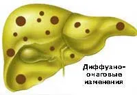 Какво е дифузни и огнищни промени