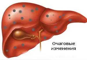 Какво е дифузни и огнищни промени