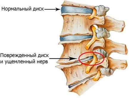 Какво е chondrosis и как да се лекува