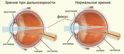 Далекогледство симптоми, профилактика и лечение на далекогледство