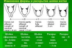 Миометриума hypertonus причинява симптомите и лечението