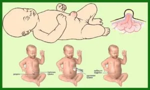 Херния в новородено симптоми, лечение и превенция