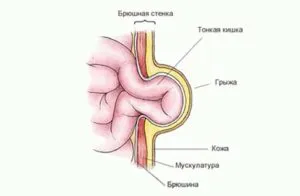 Херния в новородено симптоми, лечение и превенция