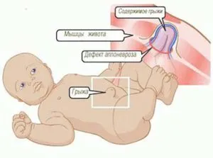 Херния в новородено симптоми, лечение и превенция