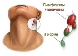 Как за лечение на лимфните възли