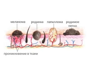 Как да се разграничи брадавица на мол - и разлики