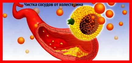 Как да се чисти на съдовете на мозъка от холестерол