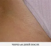 Как да използвате епилатора за да се избегне нараняване