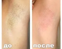 Как да използвате епилатора за да се избегне нараняване