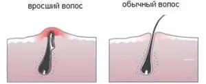 Как да използвате епилатора за да се избегне нараняване