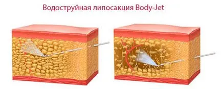 Как да премахнете мазнините от отзад и отстрани бързо