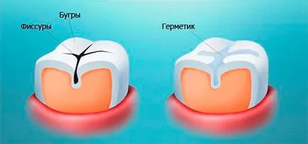 Как да се предпазите зъбите от кариес и за да се предотврати възникването му (кариес) Как да се предпазите зъбите от кариес и за да се предотврати възникването му