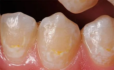 Как да се предпазите зъбите от кариес и за да се предотврати възникването му (да се пази зъбите от кариес) Как да се предпазите зъбите от кариес и за да се предотврати възникването му