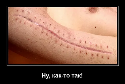 Как да се зашие раната