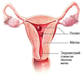Мензес кафяви, тъмни съсирена причини, които правят (месечно) Мензес кафяви, тъмни съсирена причини, които правят