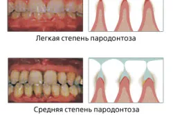 Лечение на пародонтит лазер