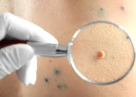 Calluses на ръцете причини и начини за борба с