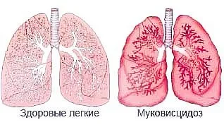 Муковисцидоза в детските симптоми и лечение