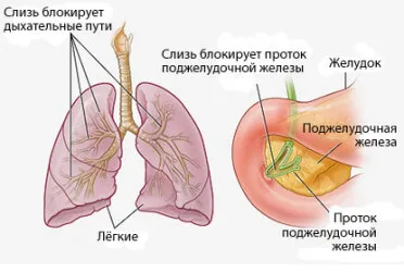 Муковисцидоза в детските симптоми и лечение