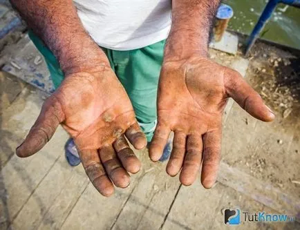 Calluses на ръцете причини и начини за борба с