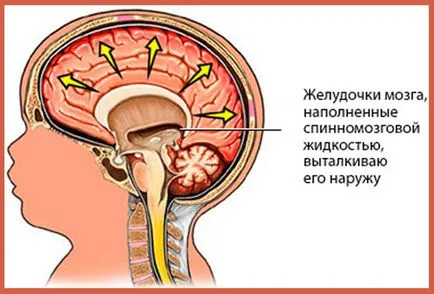 Външно мозъка хидроцефалия какво е, симптоми и лечение