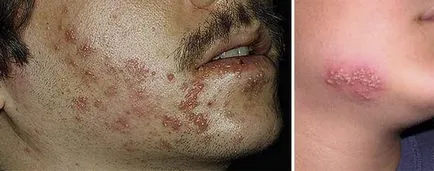 Херпес зостер - причини, симптоми, лечение