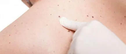 Има бенки са опасни и дали да ги изтриете