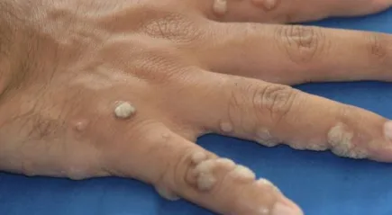 От които има брадавици