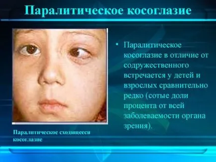 Паралитичен страбизъм при възрастни и деца конвергентни, различаващи се, упражнения, лекарства е