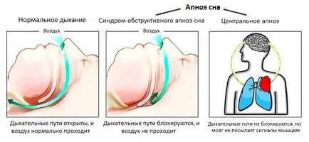 Защо спиране на дишането при заспиване - причини и лечение