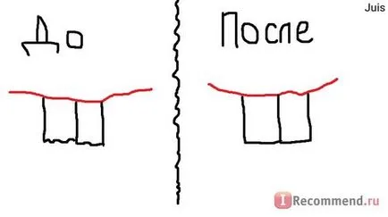 зъби подстригване - 