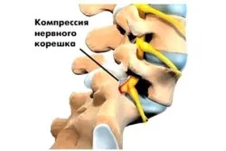 Лумбални дегенеративни диск болестни причини, симптоми, лечение