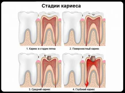 Surface емайлирани кариес клиника, диагностика, лечение, последствия, превенция